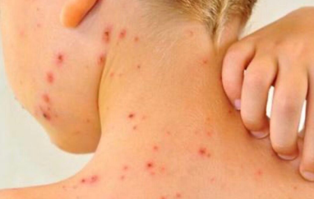 ABD`de Tatil seyahatlerinin yoğunlaştığı günlerde, dünyanın en bulaşıcı hastalıklarından biri